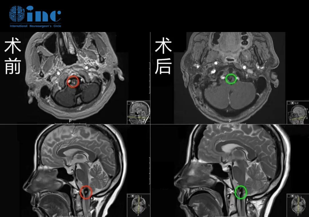 颈髓海绵状血管瘤手术治疗案例