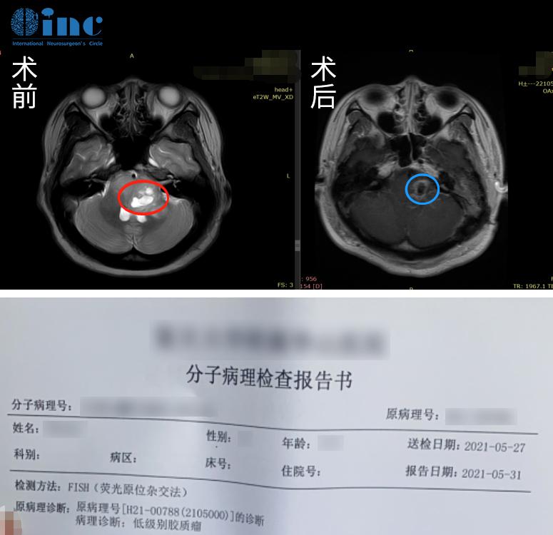 脑干胶质瘤手术案例