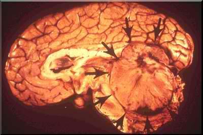 【髓母细胞瘤病因】是什么引起了这个儿童恶性脑瘤？