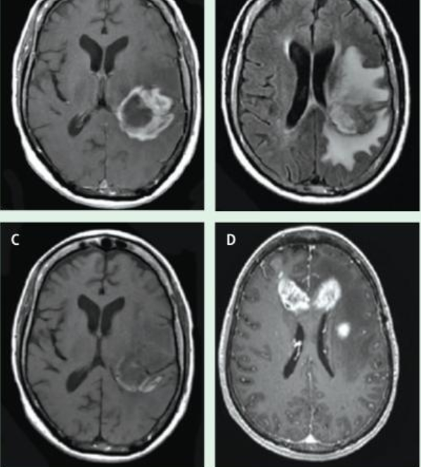四级胶质瘤：胶质母细胞瘤症状表现有哪些？