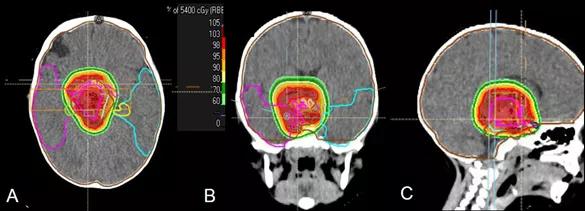 质子治疗脑瘤