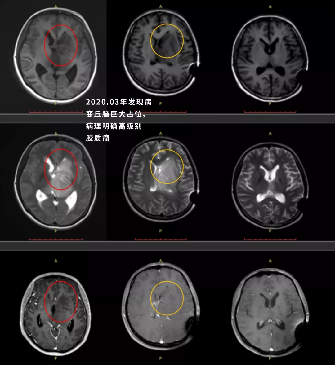 丘脑胶质瘤较佳的治疗效果可以怎样？6个成功治疗故事告诉你