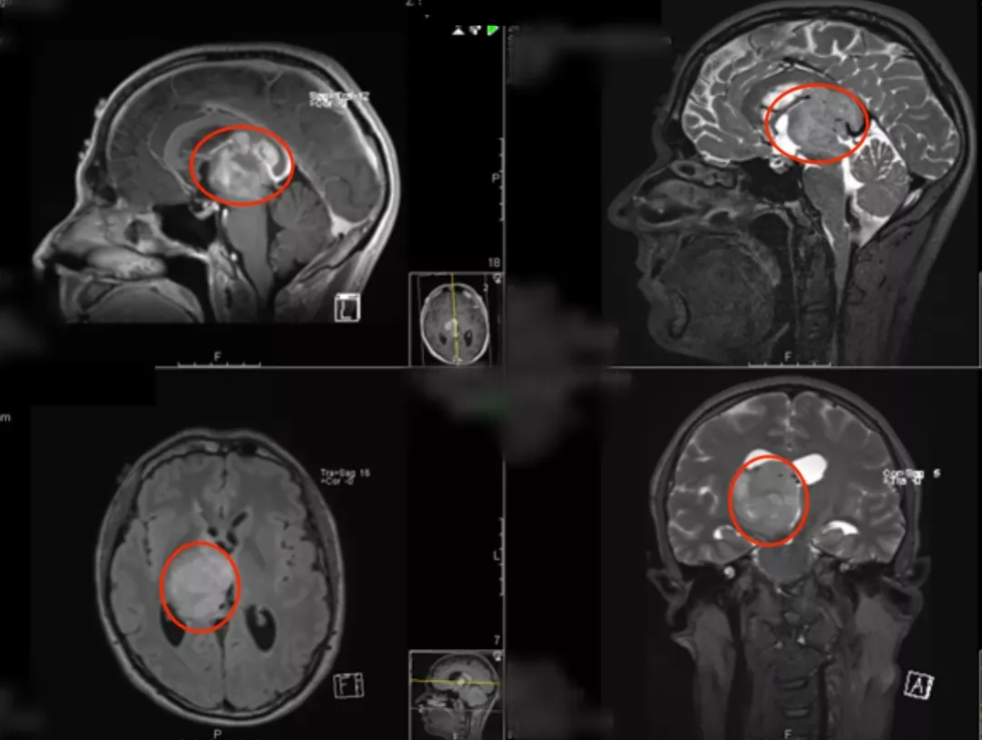 丘脑胶质瘤较佳的治疗效果可以怎样？6个成功治疗故事告诉你