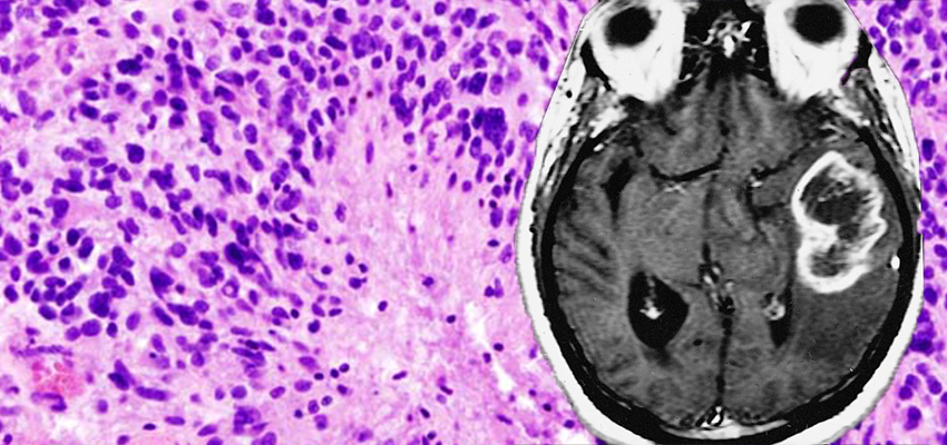 胶质母细胞瘤总是致命的吗？症状体征、发病原因、治疗及预后