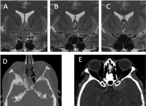 鞍旁脑膜瘤诊断