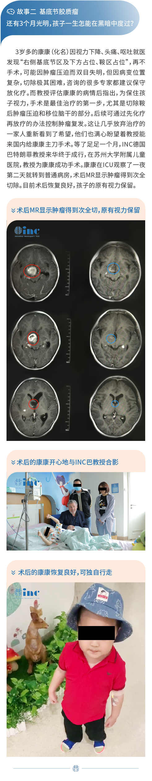 基底节胶质瘤