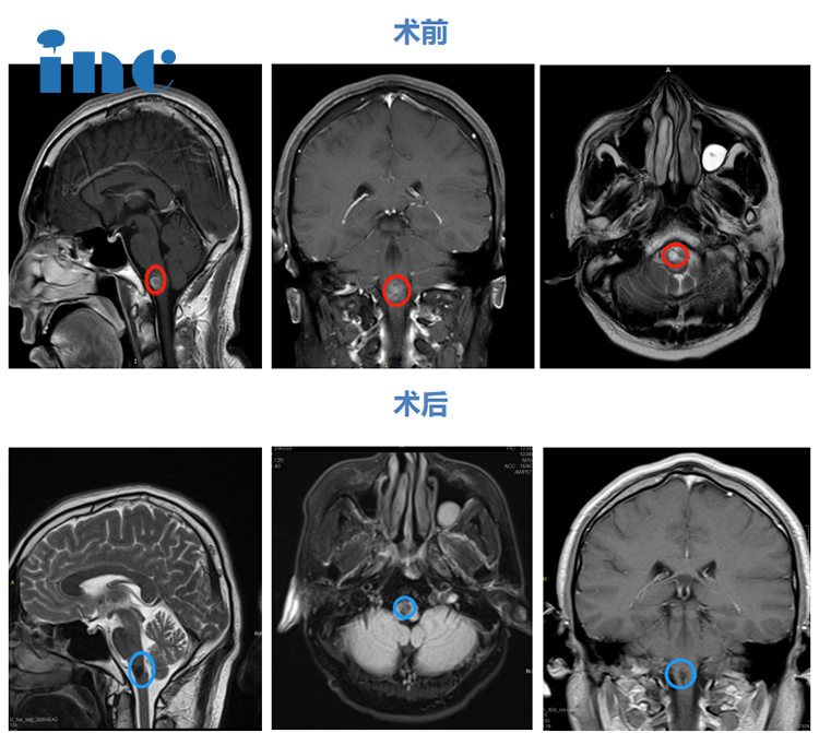 脑干延髓海绵状血管瘤