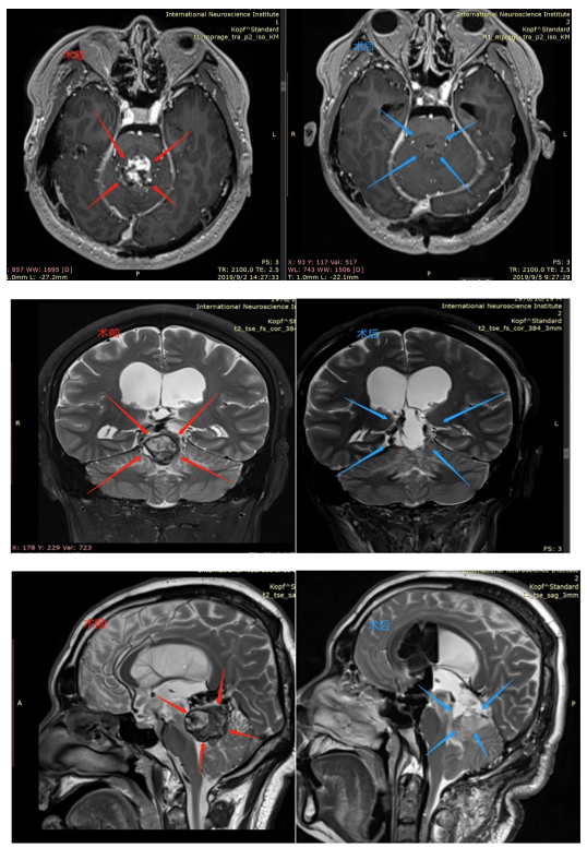 松果体区肿瘤案例