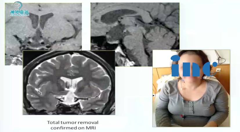脑肿瘤案例