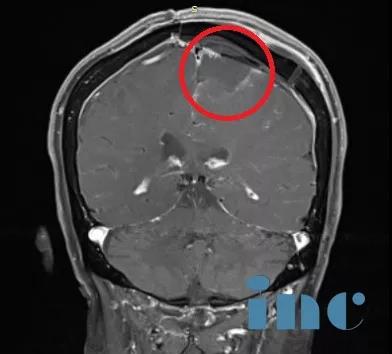 脑膜瘤案例,脑膜瘤治疗