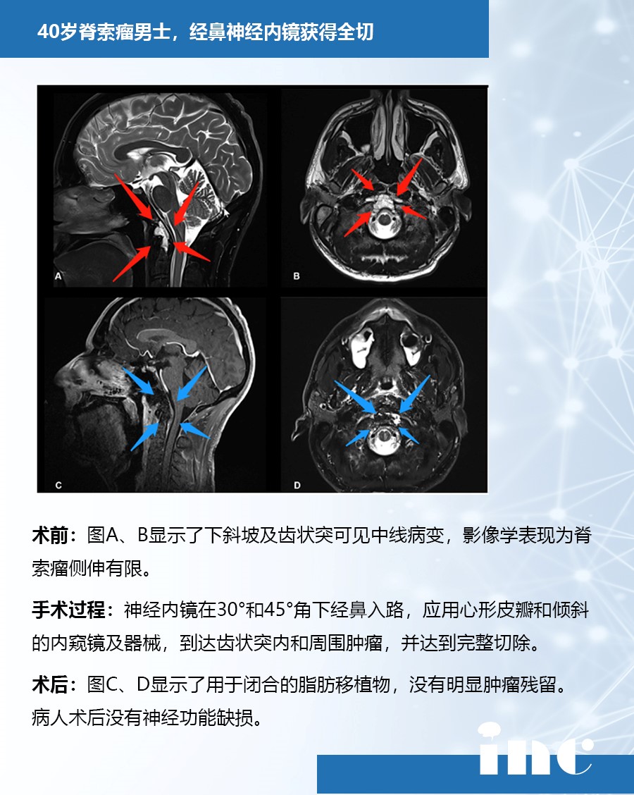 脊索瘤案例