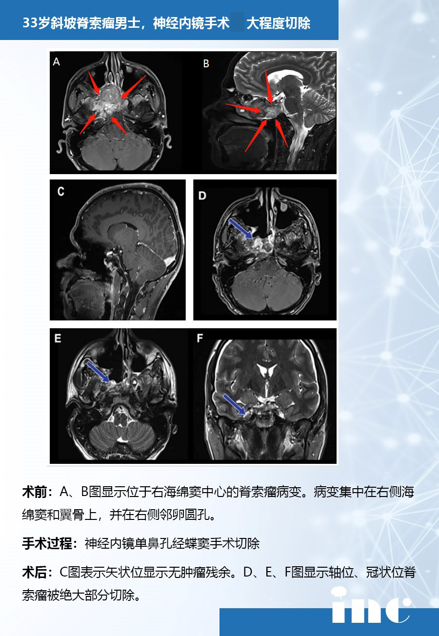 斜坡脊索瘤案例