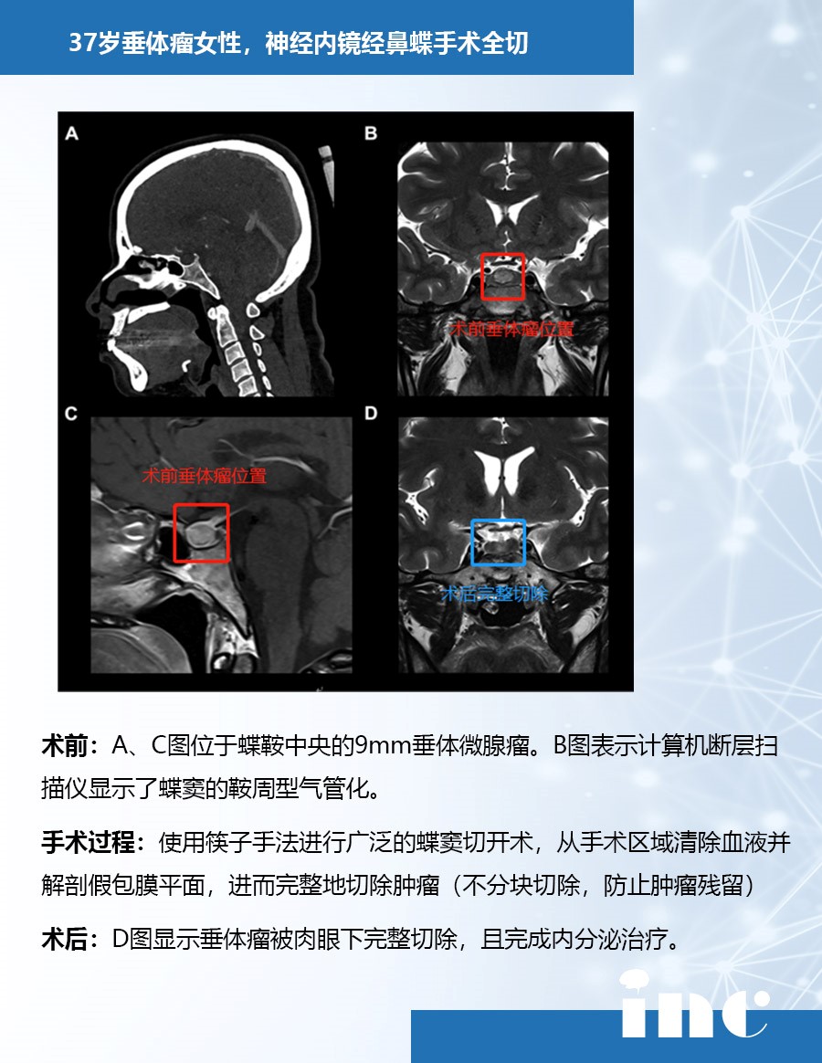 垂体瘤案例