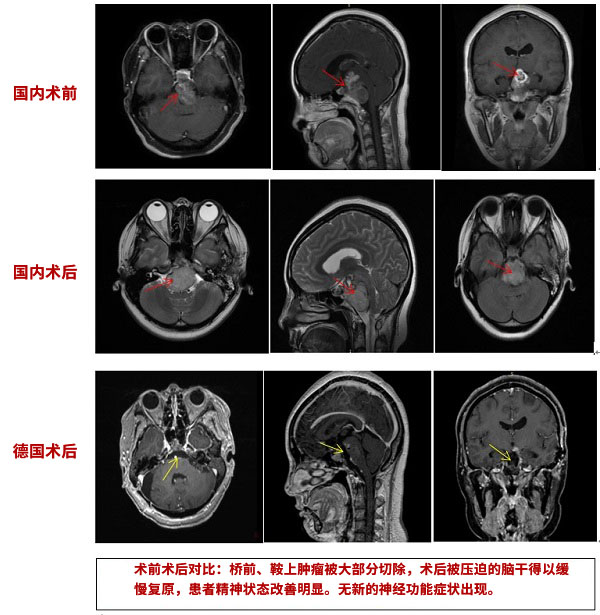 脊索瘤案例