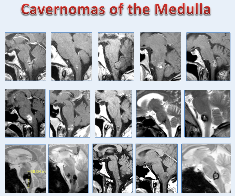 巴教授延髓海绵状血管瘤