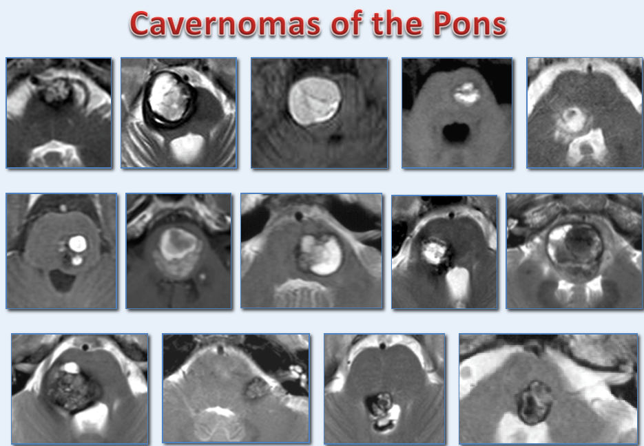 脑干海绵状血管瘤