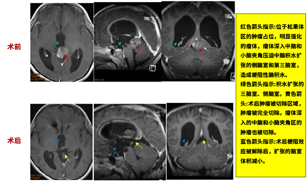 松果体区案例,松果体区肿瘤手术