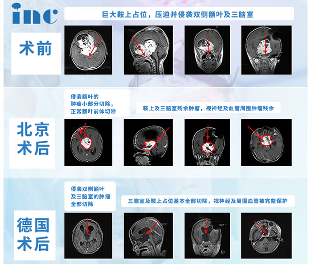 视神经胶质瘤案例