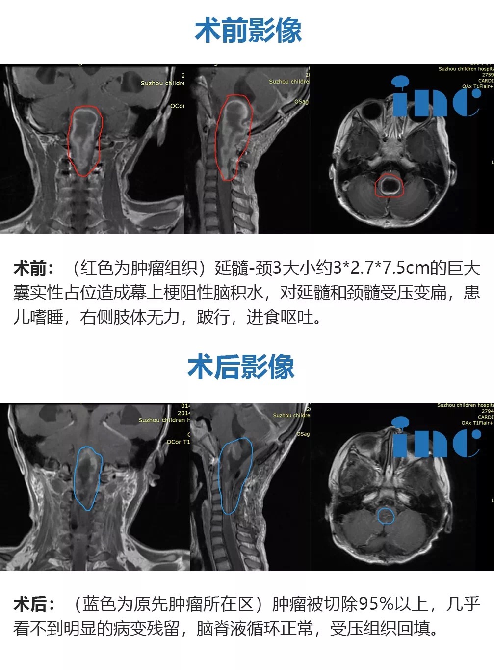 脑干延髓巨大肿瘤