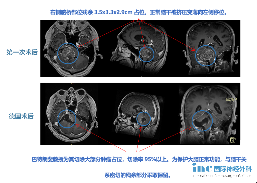 脑干胶质瘤案例