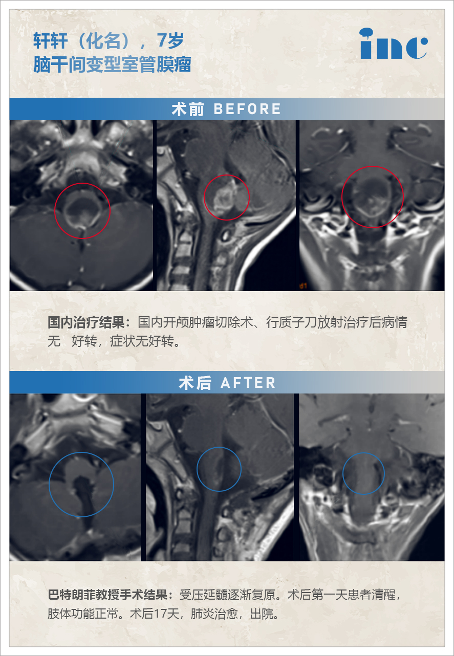 脑干肿瘤室管膜瘤案例