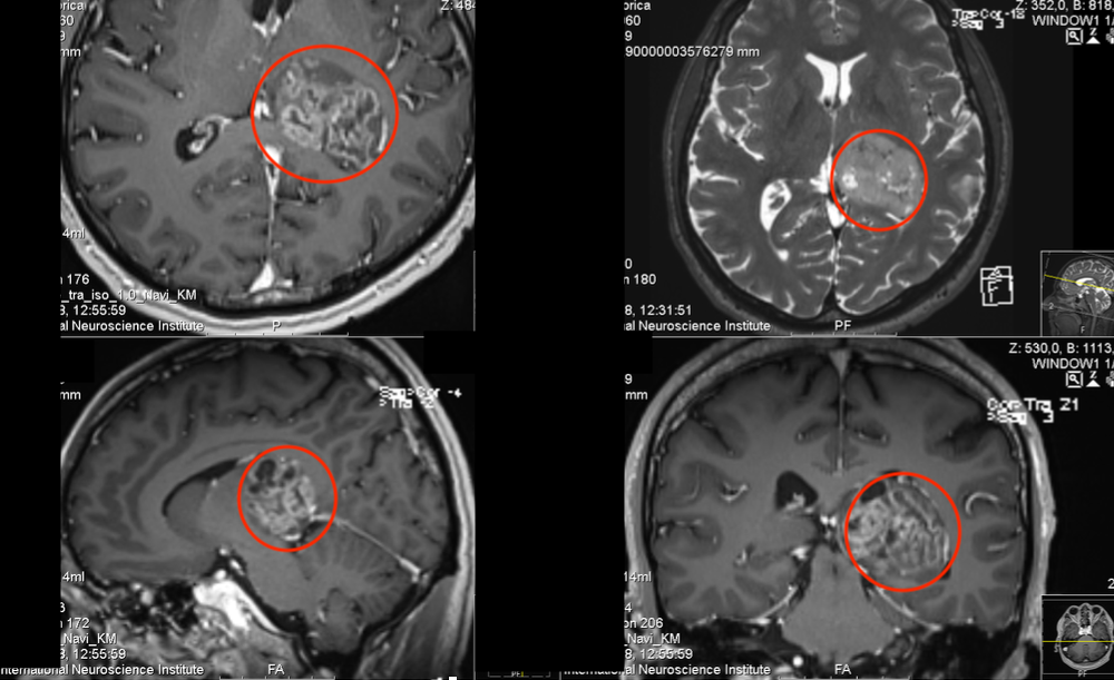 丘脑胶质瘤案例