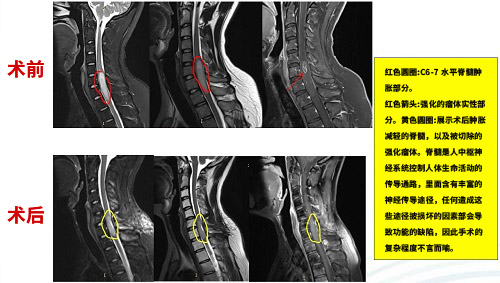 脊髓肿瘤治疗