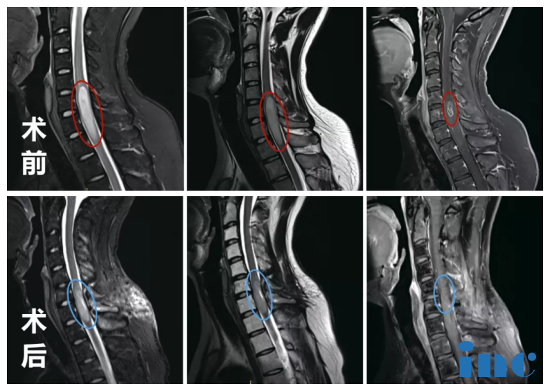 脊髓内肿瘤案例