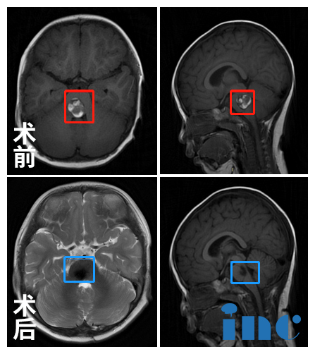 脑干<a href='/jiaozhiliu/' target='_blank'><u>胶质瘤</u></a>案例