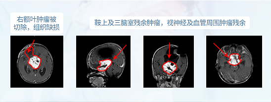 <a href='/jiaozhiliu/' target='_blank'><u>胶质瘤</u></a>手术