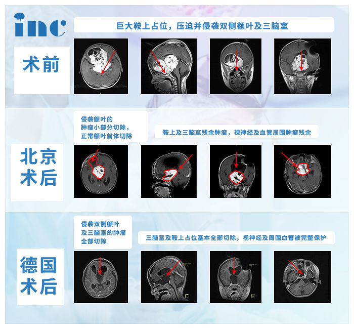 视神经胶质瘤案例