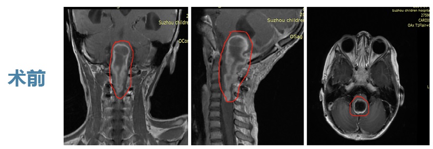 脑胶质瘤案例术前