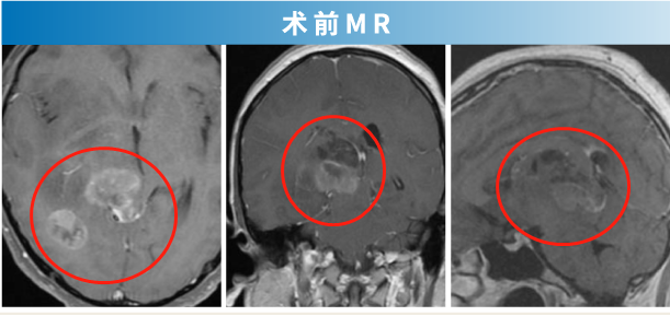 脑胶质瘤