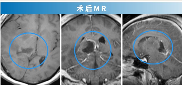 脑胶质瘤