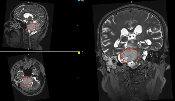 脑干胶质瘤案例