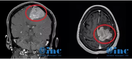 巨大脑膜瘤MR