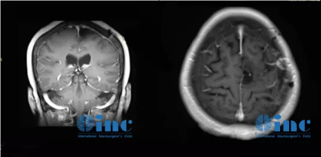 巨大脑膜瘤术后MR