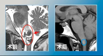 脑海绵状血管瘤严重吗？脑干海绵状血管瘤可以手术吗？