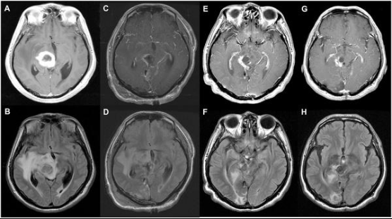 丘脑胶母GBM案例1