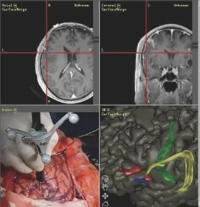 术中神经导航系统所显示的影像