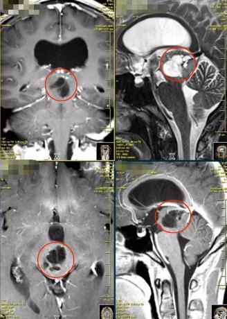 小齐术前MRI