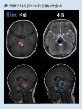 脑干海绵状血管瘤1