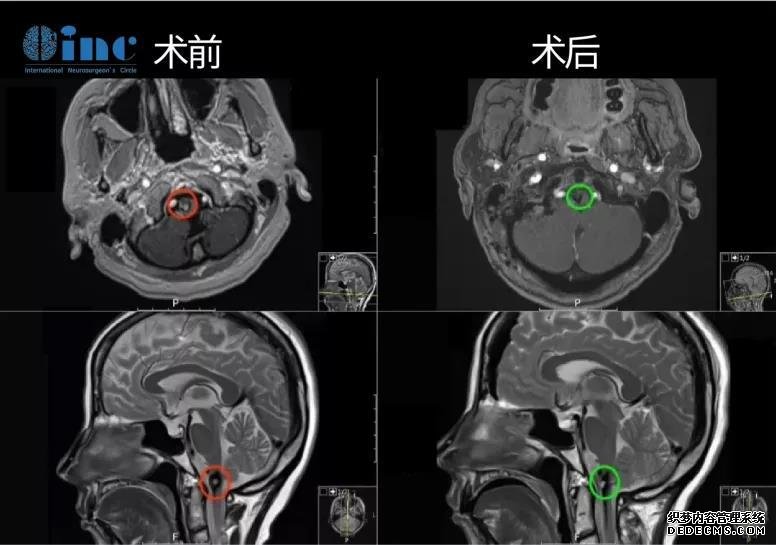 脑干海绵状血管瘤案例