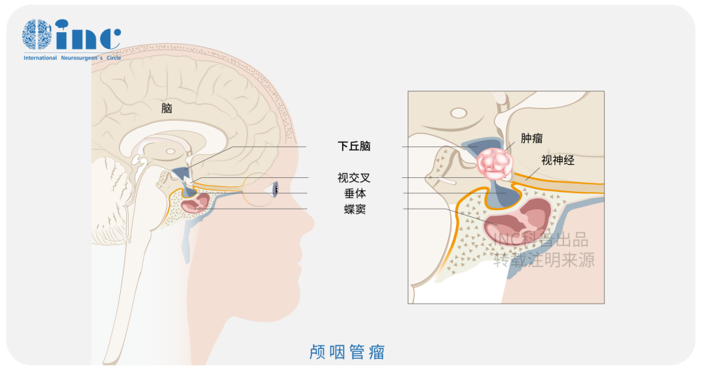 颅咽管瘤能活多久