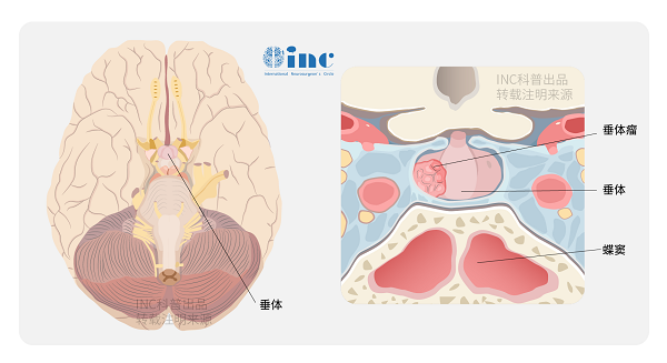 <a href='/naochuitiliu/' target='_blank'><u>垂体瘤</u></a>有哪些症状表现