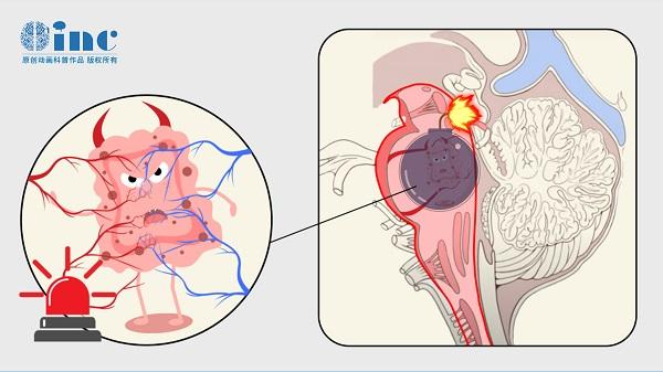 脑干海绵状血管瘤出血严重吗？脑干海绵状血管瘤出血后怎样治疗？