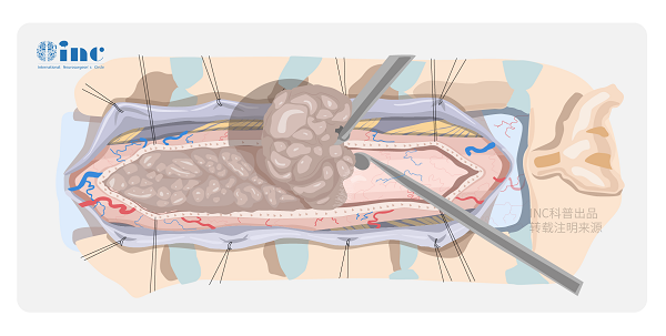 脊髓室管膜瘤严重吗？脊髓室管膜瘤怎么治疗？