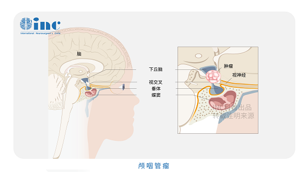 颅咽管瘤术后能活多久