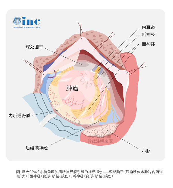 CPA区脑膜瘤比较严重吗？CPA区脑膜瘤手术怎么治疗？