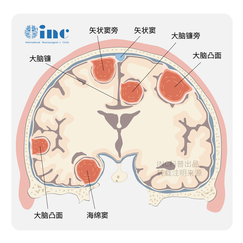 鞍区脑膜瘤的症状和临床表现有